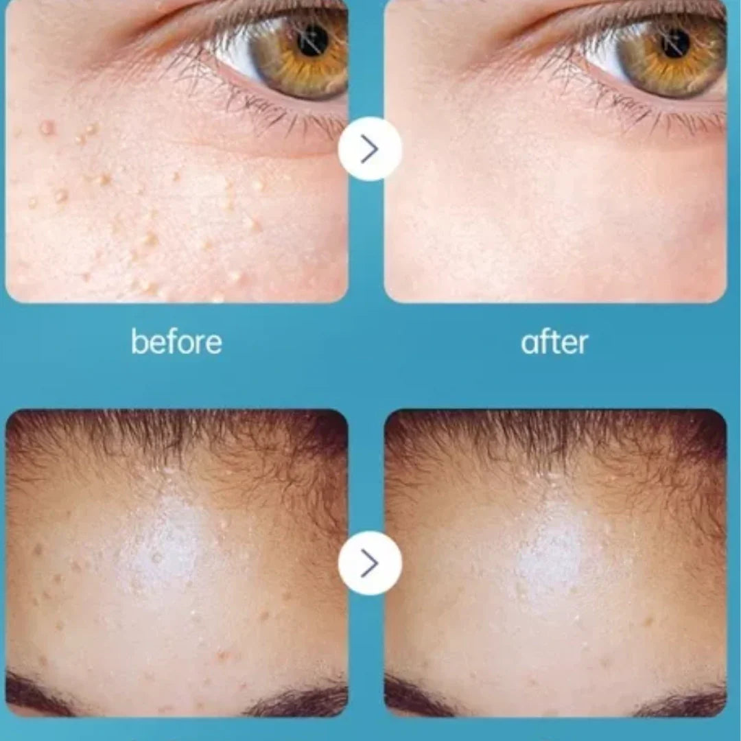 Crema removedora de verrugas⭐