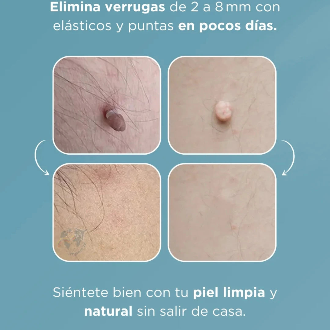 Lápiz removedor de verrugas - rápido y sin dolor