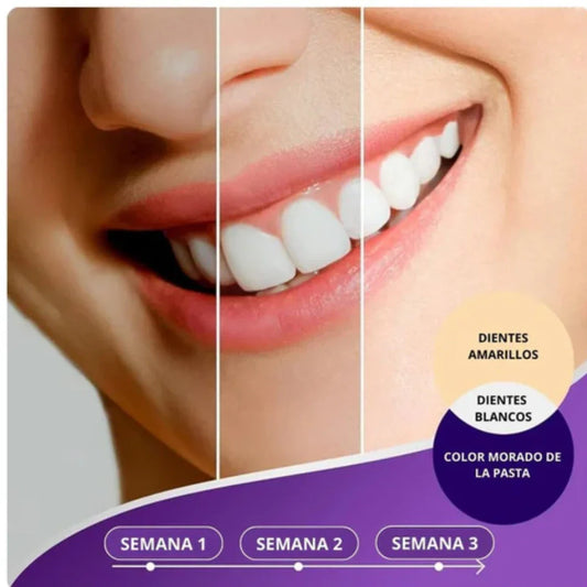Blanqueamiento dental casero HiSmile®︎🦷🌟